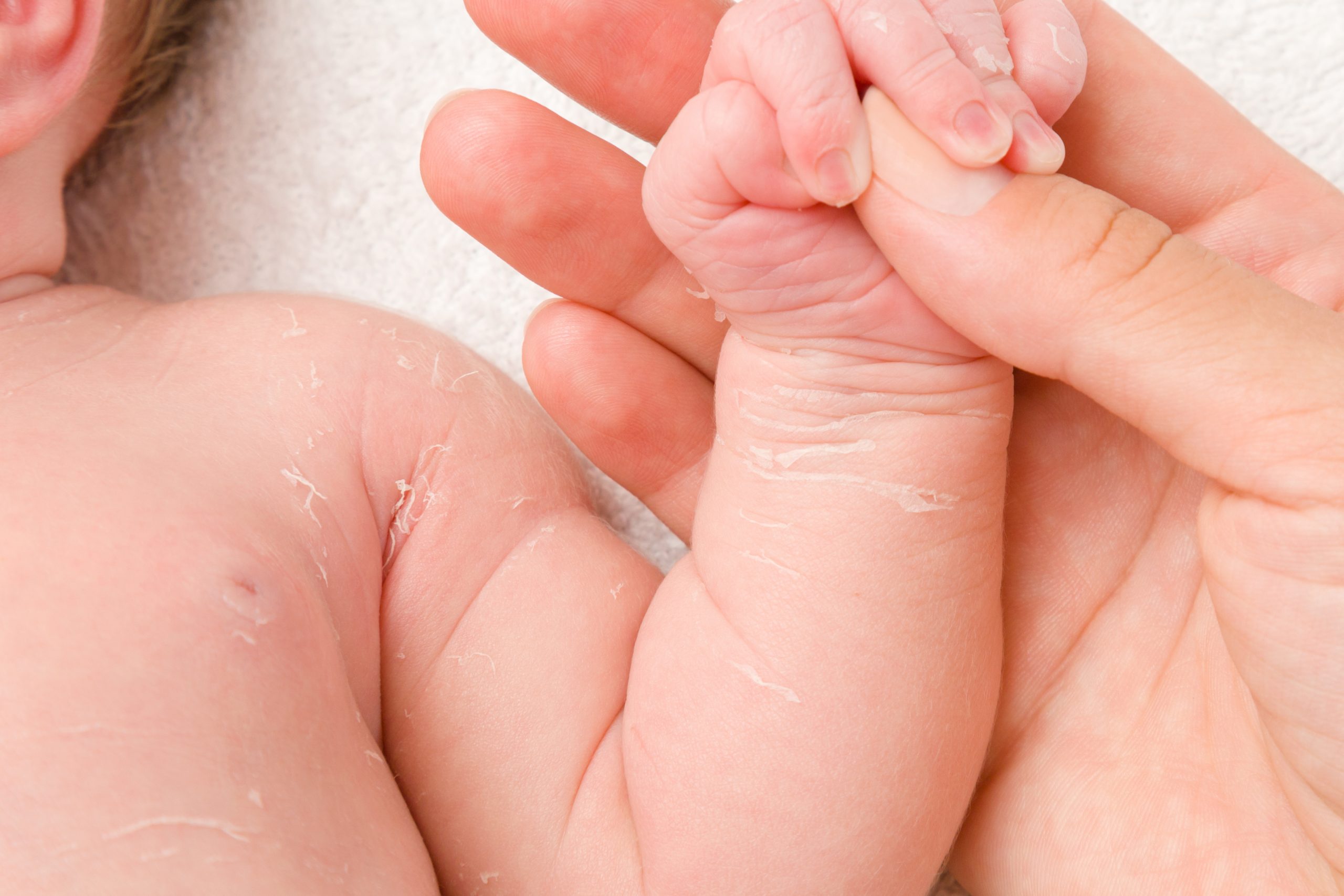 Natuurlijke verzorging bij baby met droge huid