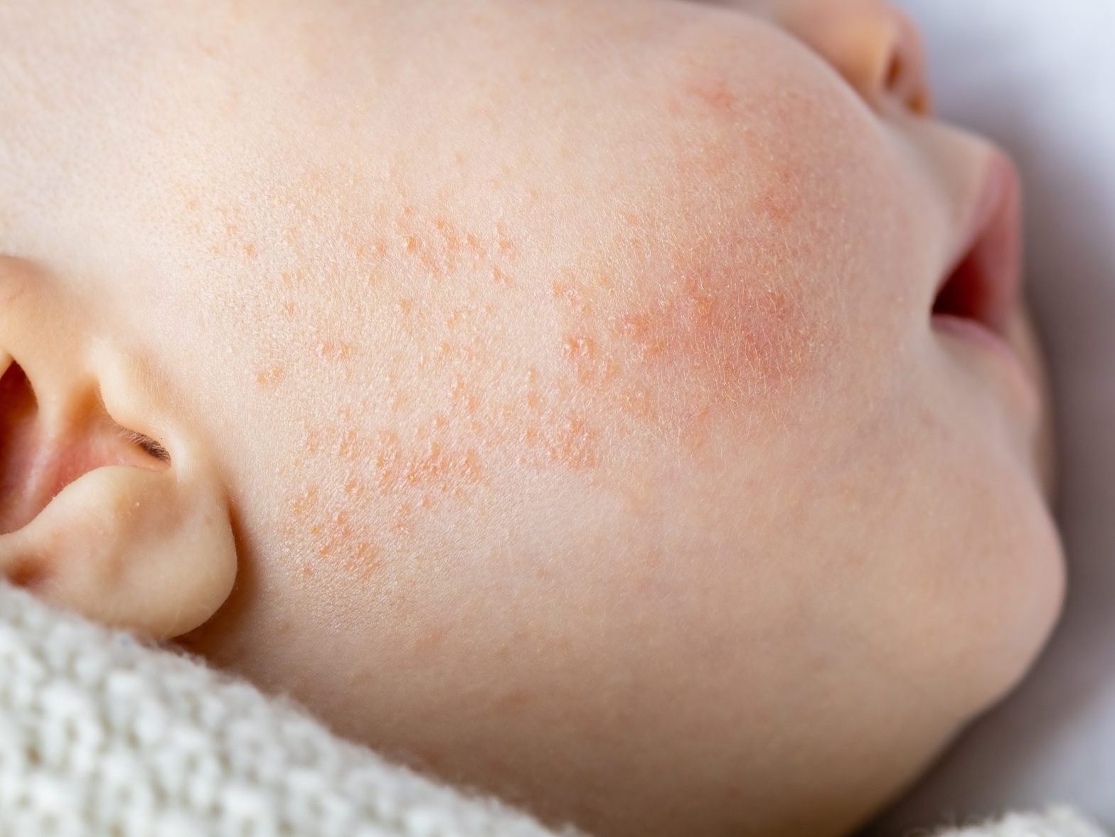 Baby acne: wat is het écht en wat kun je doen? - de Keuken